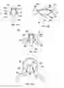 Fig. 06 - Systems and methods for reshaping a heart valve