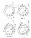 Fig. 16 - Methods, devices, and systems for percutaneously anchoring annuloplasty rings