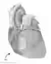 Fig. 01 - Devices and methods for treating functional tricuspid valve regurgitation