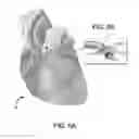 Fig. 06 - Devices and methods for treating functional tricuspid valve regurgitation