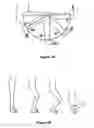 Fig. 02 - Systems and methods for providing a stem on a tibial component