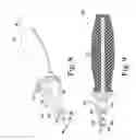 Fig. 06 - Stemless humeral component of an orthopaedic shoulder prosthesis