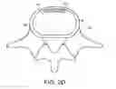 Fig. 06 - In-situ formed intervertebral fusion device and method