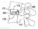 Fig. 01 - Lateral spondylolisthesis reduction cage