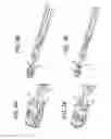 Fig. 06 - Lateral spondylolisthesis reduction cage