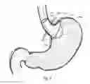 Fig. 09 - Bariatric device and method