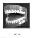 Fig. 03 - Oral anesthesia application