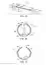 Fig. 02 - METHODS AND SYSTEMS FOR TREATING ISCHEMIC TISSUES
