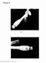 Fig. 06 - Catheter for treatment of sinusitis