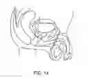 Fig. 15 - Device implantable in tissue of a prostate gland or a bladder