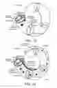 Fig. 03 - Hearing assistance system with improved signal processing comprising an implanted part