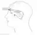 Fig. 01 - Devices and methods for treating craniofacial pain