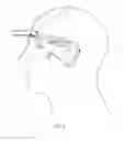 Fig. 06 - Devices and methods for treating craniofacial pain