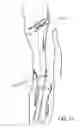 Fig. 17 - Devices and methods for treating craniofacial pain