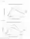 Fig. 08 - Methods for treating ulcers in thalassemia syndrome with an ActRIIB polypeptide