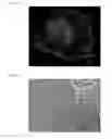 Fig. 15 - THREE-DIMENSIONAL BIOPRINTED PANCREATIC TUMOR MODEL