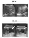 Fig. 07 - Mutations in DSTYK cause dominant urinary tract malformations