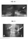 Fig. 08 - Mutations in DSTYK cause dominant urinary tract malformations