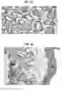 Fig. 10 - Mutations in DSTYK cause dominant urinary tract malformations