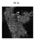 Fig. 11 - Mutations in DSTYK cause dominant urinary tract malformations