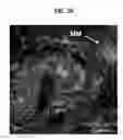 Fig. 14 - Mutations in DSTYK cause dominant urinary tract malformations