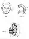 Fig. 02 - External ear insert for hearing comprehension enhancement