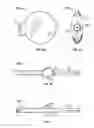 Fig. 12 - Antiseptic bracelet