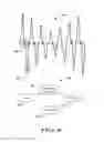 Fig. 07 - Methods and implantable devices for detecting arrhythmia