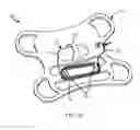 Fig. 11 - Designs and methods to facilitate swallowing of a tethered cell collection device
