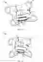 Fig. 12 - Designs and methods to facilitate swallowing of a tethered cell collection device
