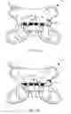 Fig. 19 - Designs and methods to facilitate swallowing of a tethered cell collection device