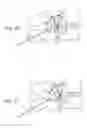 Fig. 13 - Methods, systems, and devices for the treatment of stenosis