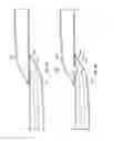 Fig. 06 - Anastomosis devices