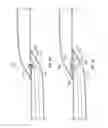 Fig. 07 - Anastomosis devices