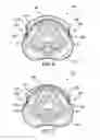 Fig. 04 - C-tourniquet