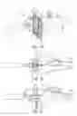 Fig. 02 - Positioning and template system for preparing a femur for knee replacement