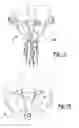 Fig. 09 - Bi-cruciate knee system