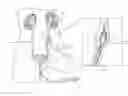 Fig. 01 - Kidney stone suction device