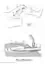 Fig. 02 - Single-pass endoscopic vessel harvesting
