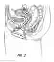Fig. 03 - Natural orifice surgery system