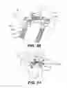 Fig. 04 - Interspinous vertebral stabilization devices