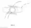 Fig. 04 - Interspinous fusion device