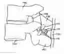 Fig. 01 - Interspinous spacer