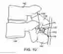 Fig. 11 - Interspinous spacer