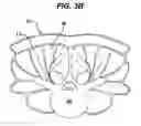 Fig. 05 - Methods and devices for spinal fixation element placement