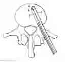 Fig. 01 - Balloon with shape control for spinal procedures