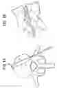 Fig. 02 - Balloon with shape control for spinal procedures