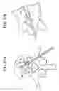 Fig. 22 - Balloon with shape control for spinal procedures
