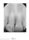 Fig. 04 - Customized root canal obturation cores and methods of making customized root canal obturation cores