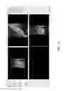 Fig. 11 - Customized root canal obturation cores and methods of making customized root canal obturation cores
